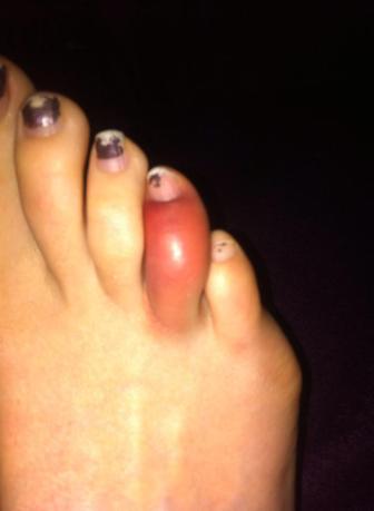 Bruised Toe